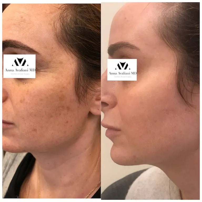 Reveal Your Best Skin With PicoSure® Focus Treatment