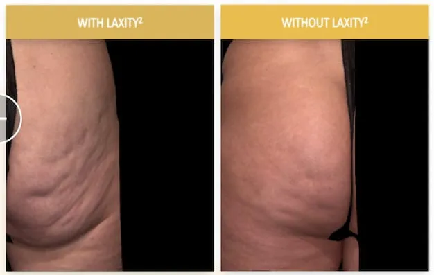 4 Must Try Procedures For Cellulite That Finally Work By NYC’s Body Expert Dr. Avaliani