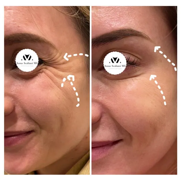 25 uses of Botox