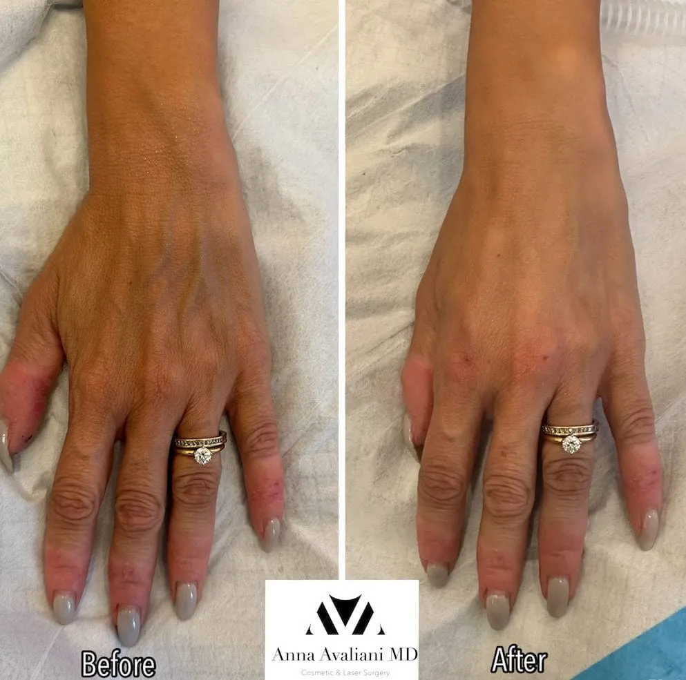 The Five Treatment Options To Combat Ozempic Hands