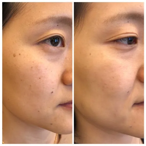 Newest and Best Lasers for Asian Skin: How to treat Hyperpigmentation and erase sun damage