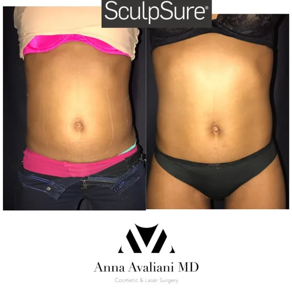 Why Choose Dr.Avaliani for your Bespoke SculpSure Treatment?