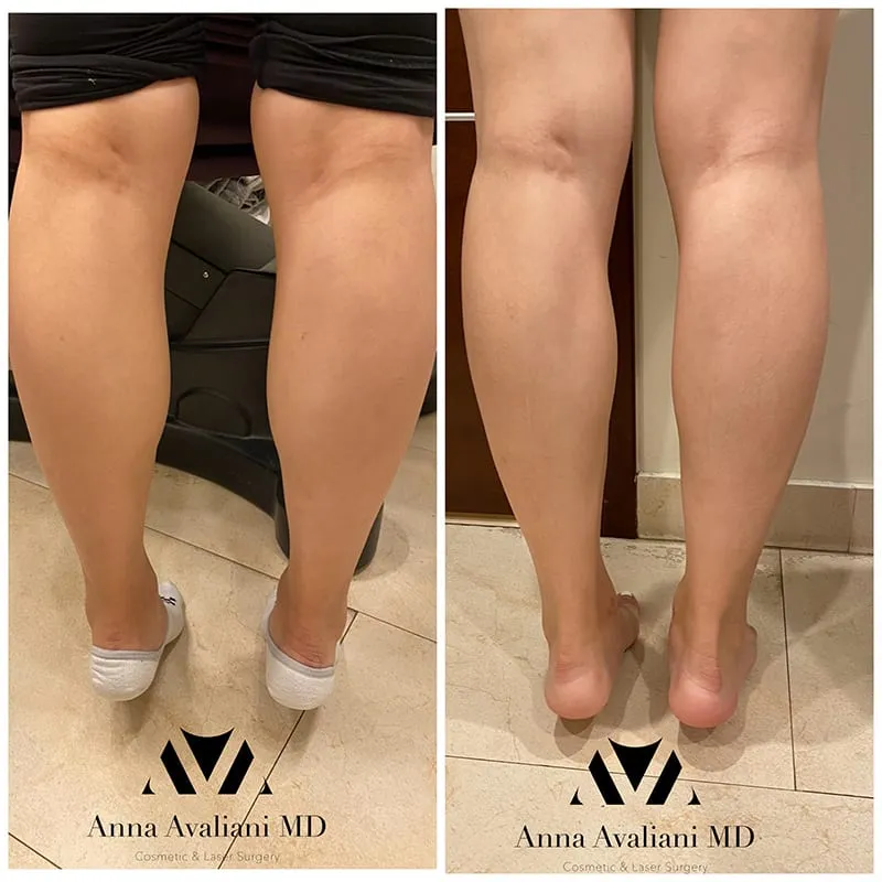 Unlocking the Secret to Slim and Toned Legs: Understanding Calf-Tox Treatment by NYC Body Expert Dr. Avaliani