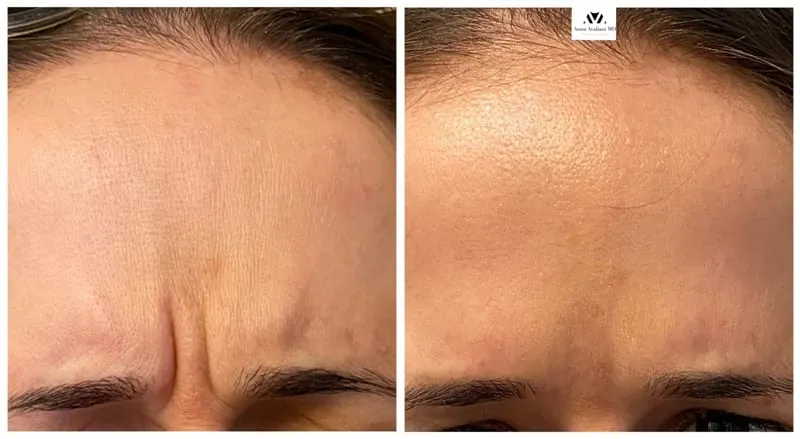 DAXXIFY vs Botox.
