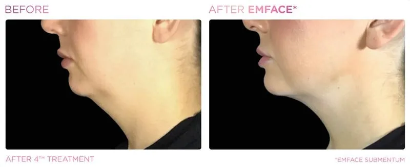 Perfect profile in only 20 minutes by Dr.Avaliani