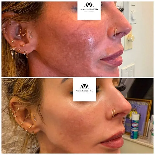 How exosomes may help melasma. New hope that is offering safe and effective solution to a very challenging problem.