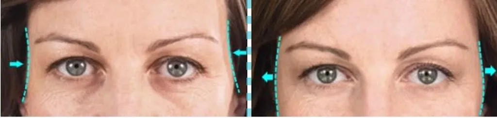 Top 5 Reasons To Get Filler Injections Into Temples For An Instant Eye Lift