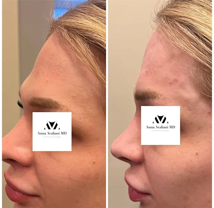 Commonly asked question about the cost, type of filler, recovery and the duration of Forehead fille injections according to Dr.Avaliani.
