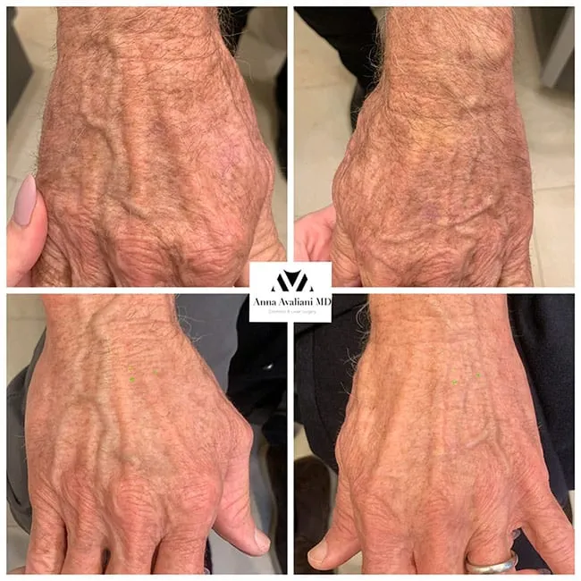 10 Non-Surgical Hand Rejuvenation Procedures To Recapture Your Hands’ Youthful Allure