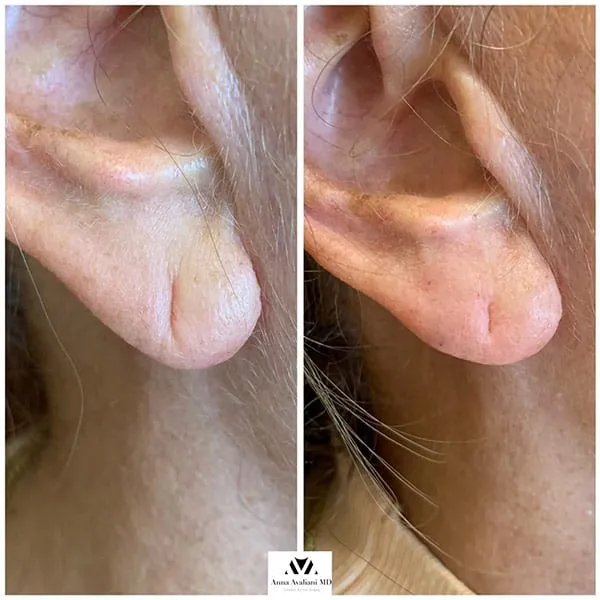 Ear Lobe Rejuvenation: The Trending Five Minute Non-Surgical Procedure