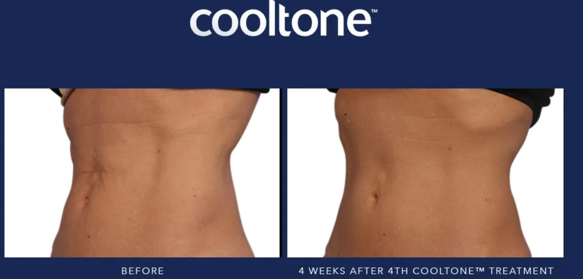 Hello CoolTone™ by Coolsculpting. Leading NYC Laser Center to offer CoolTone™ Sculpting