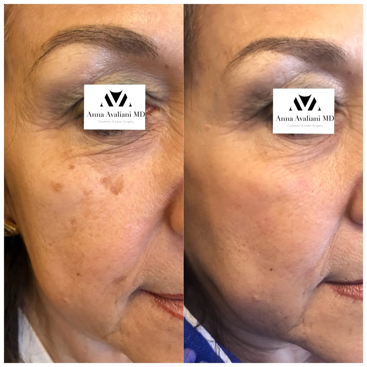 Best Melasma treatment on the market is PicoSure Focus!