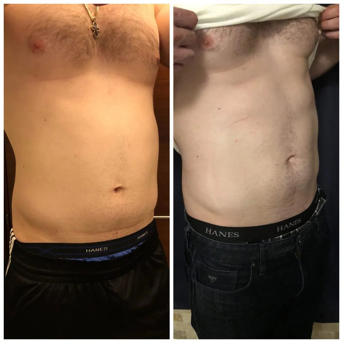 EMSCULPT Expert NYC