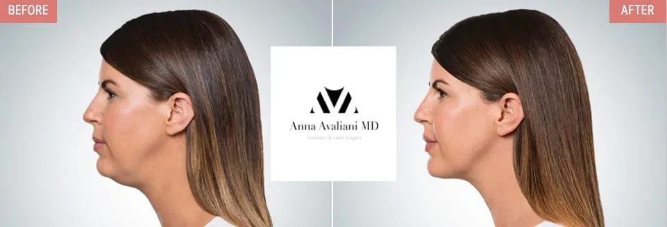 Keep your chin up! Find out what is better for under chin area: Kybella® vs Ultherapy®