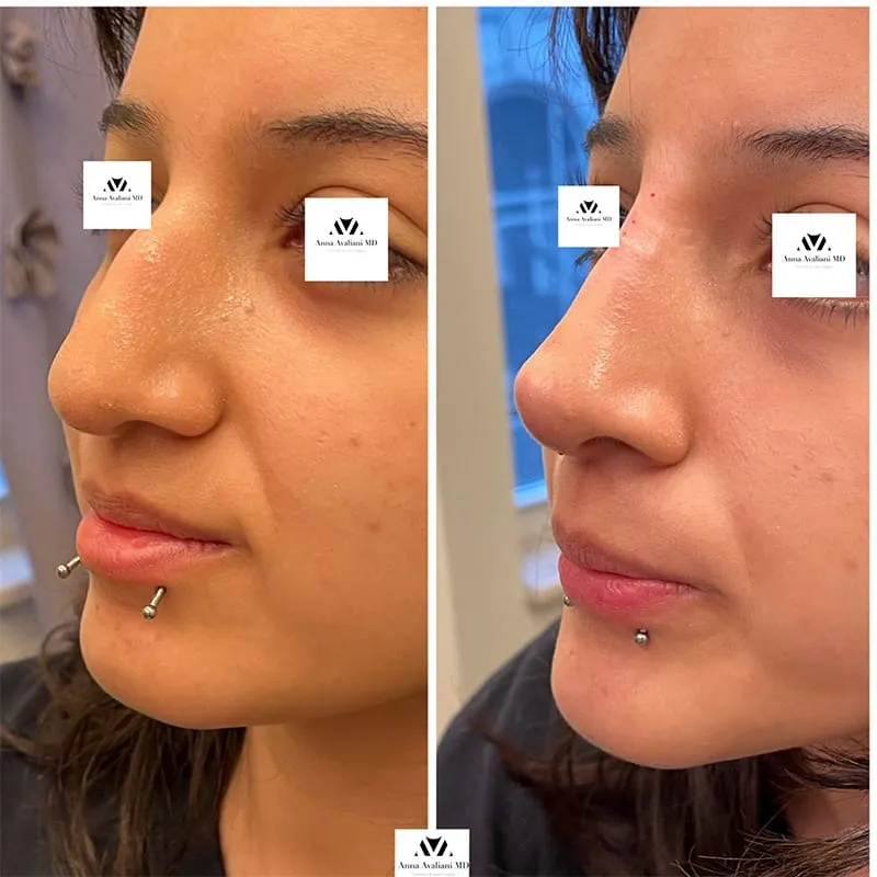 10 Benefits from Non Surgical aka Liquid Rhinoplasty procedure according to Dr. Avaliani