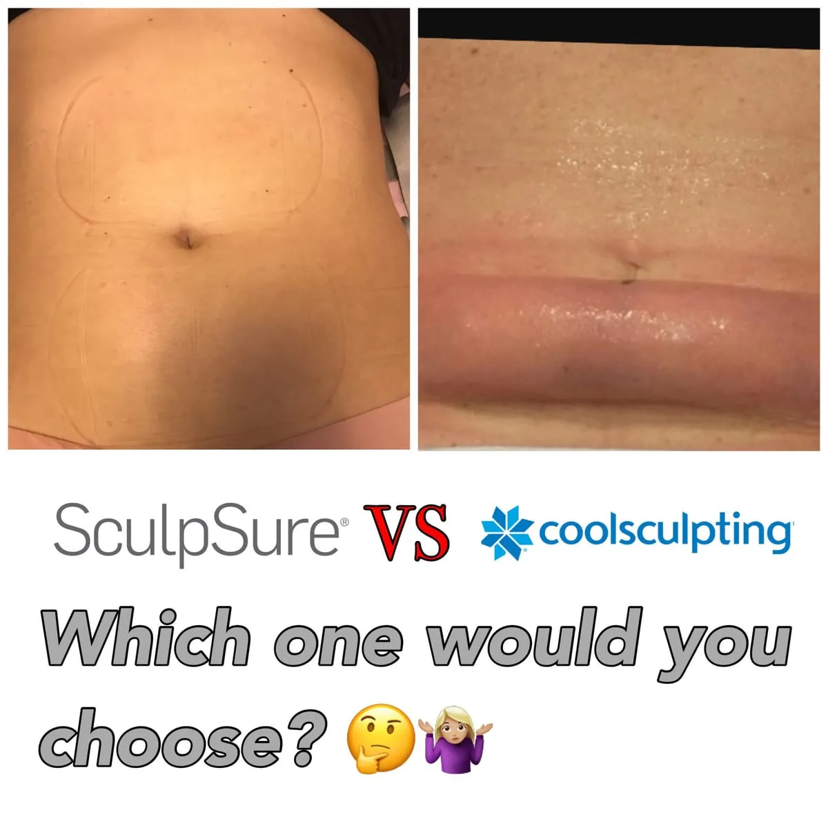 Is there any downtime after SculpSure treatment?