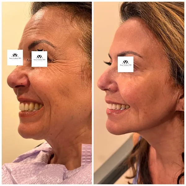 Nefertiti Neck Tox lift NYC by Dr. Avaliani