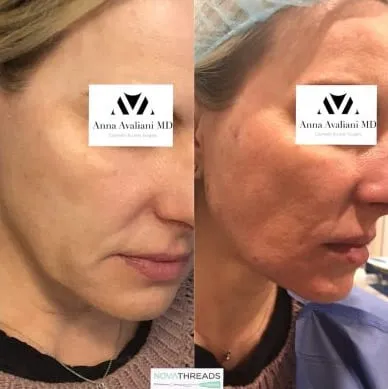 Instantly Thread Your Wrinkles Away With NovaThread Facelift
