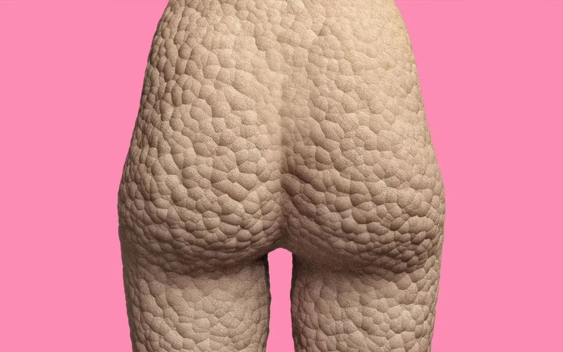 Got Cellulite? EM Revolution is happening now. EmTone and EmSculpt creating an EM Buzz