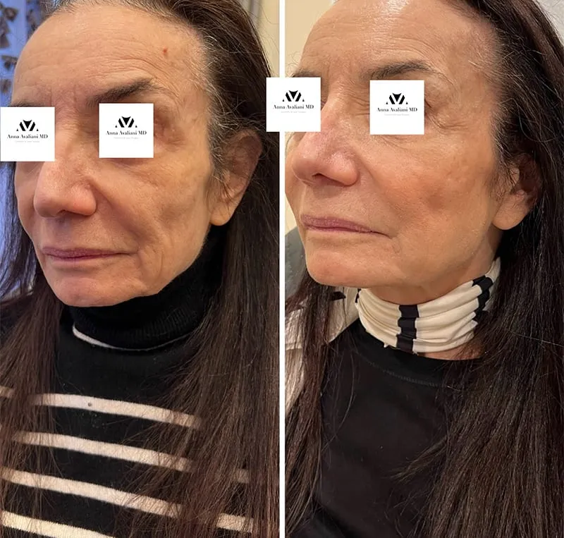 Which filler is better for Ozempic face according to Dr. Avaliani