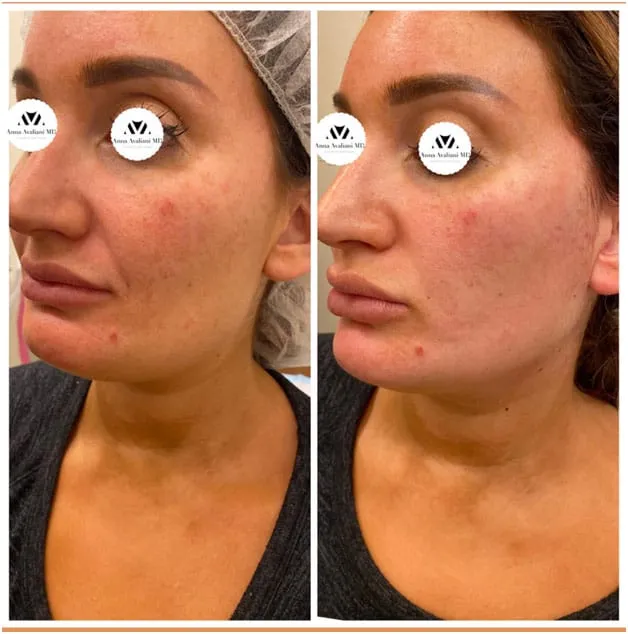 Who is an ideal Candidate for PDO Thread lift?