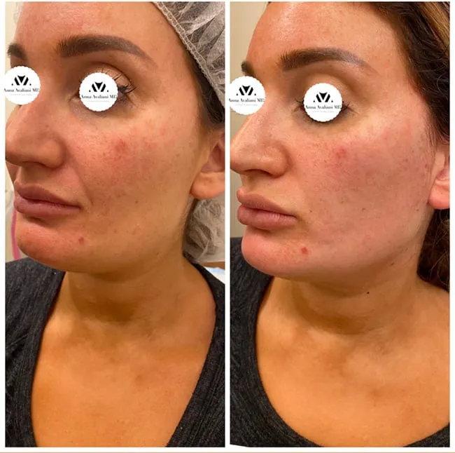 2025 Best Non Surgical Thread Face lift with upgraded threads for a bigger and better lift!