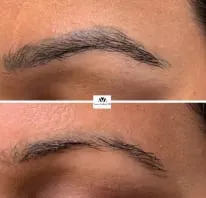 PICOSURE FOCUS: THE ROLLS-ROYCE OF SKIN REJUVENATION