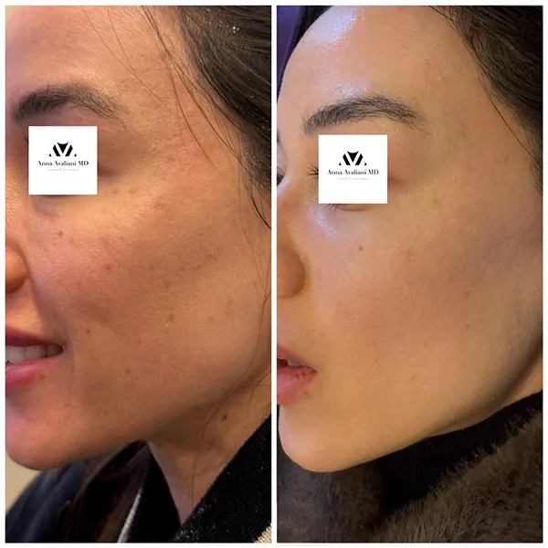 PicoSure Focus NYC before and after