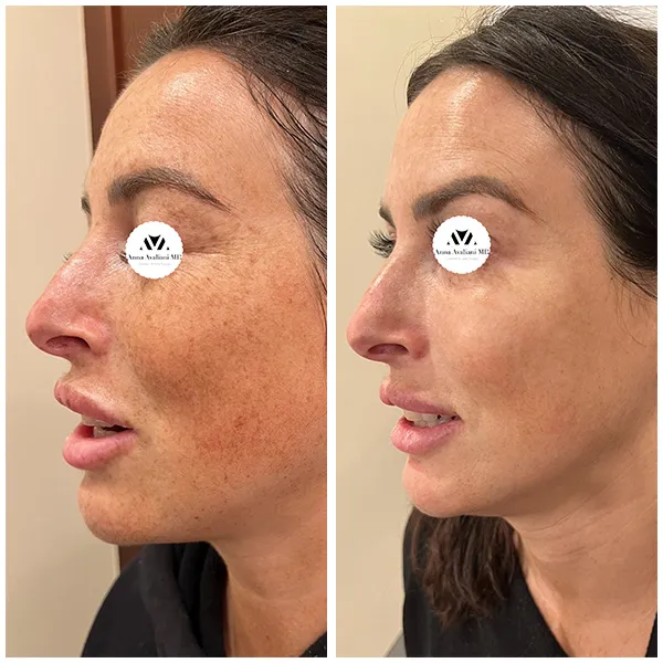 PicoSure Focus NYC before and after