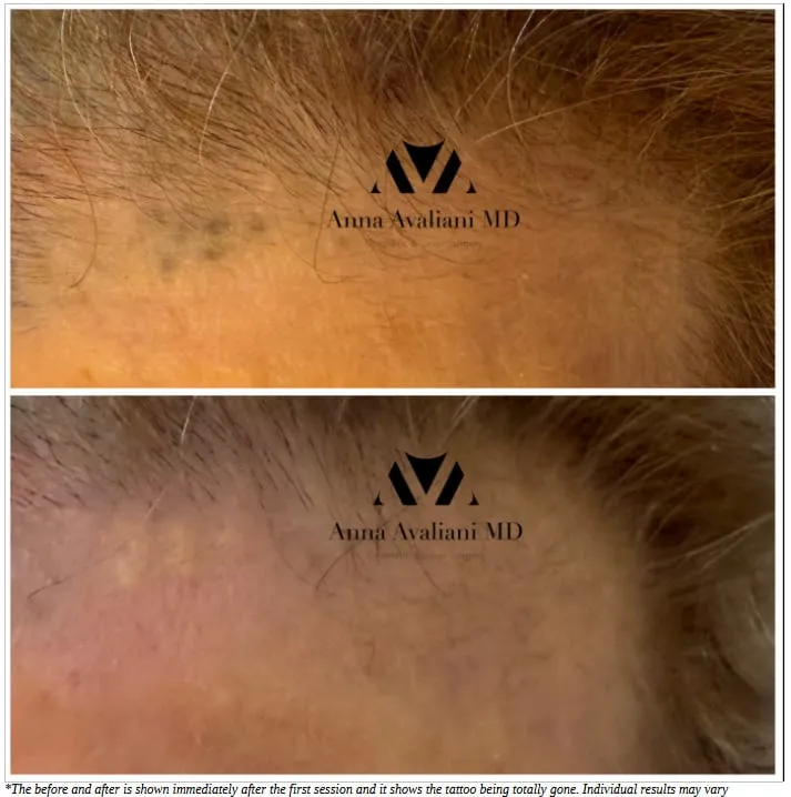 How to safely remove Pen and Pencil traumatic tattoos with Dr.Avaliani
