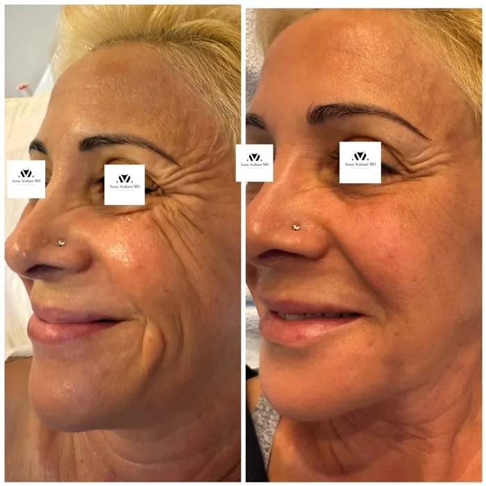 What is the difference between Polynucleotides (Rejuran ®) vs Hyaluronic acid explained by Dr. Avaliani