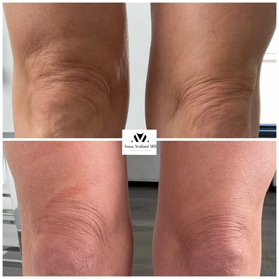 The Solution to Saggy Knees by NYC’s Body Expert Dr. Anna Avaliani