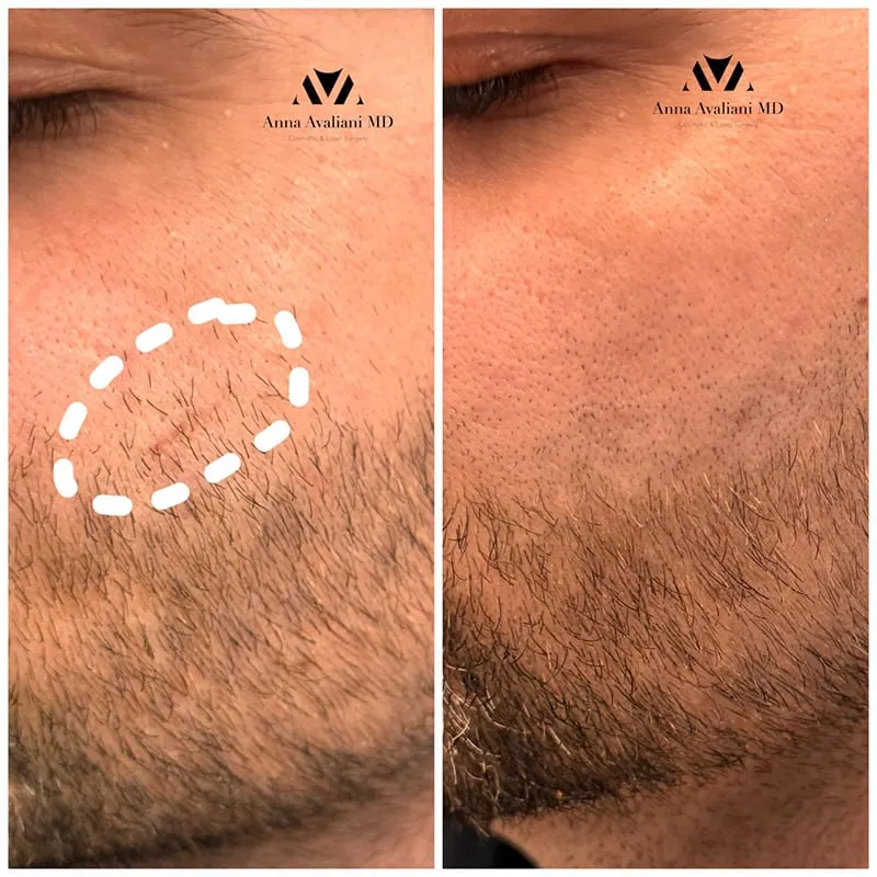 What is Scar-Tox and how is it done? The best treatment and prevention for keloid scars.