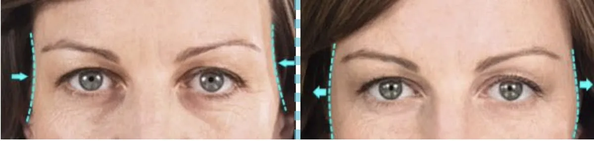Top 5 reasons to get Sculptra injection into temple area for an instant eye lift.