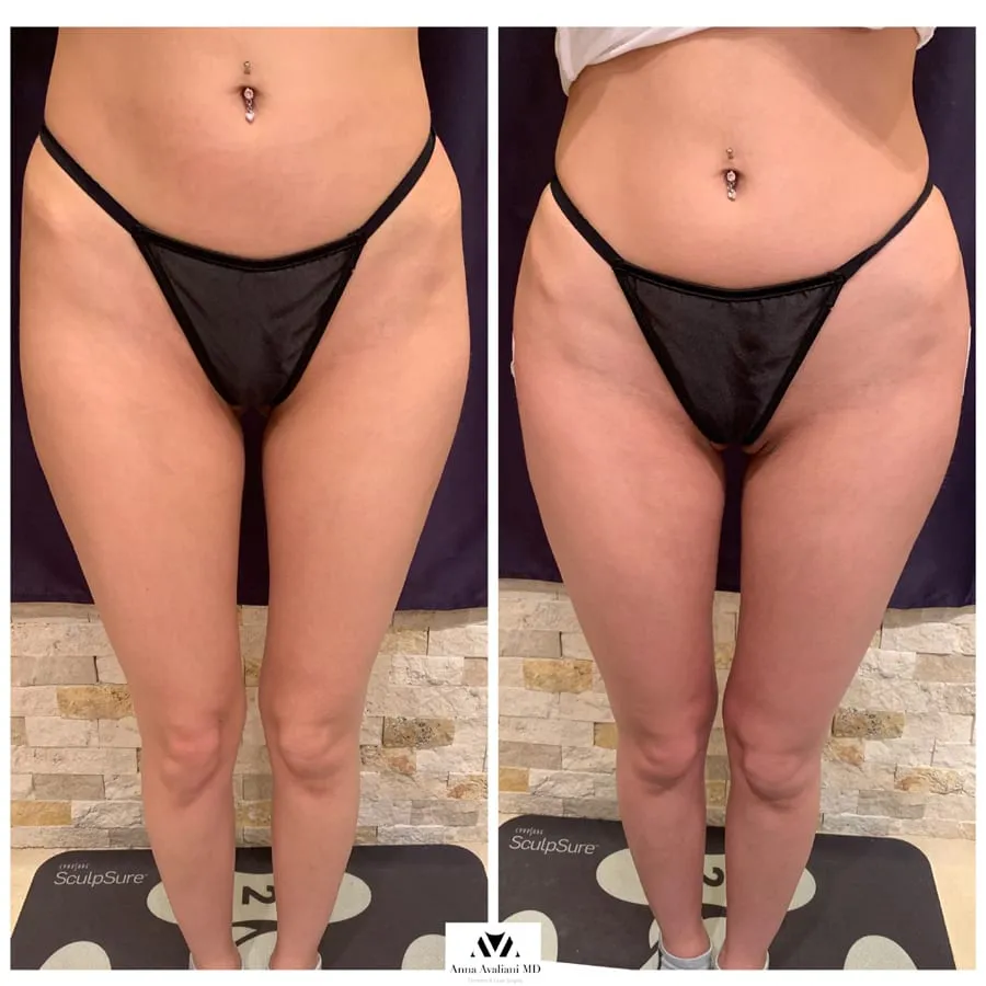 The breakdown of Sculptra Butt injection cost by Sculptra Expert NYC
