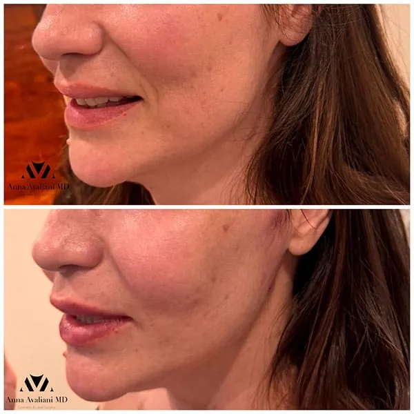 Snatched jaw line with PDO threads by threads expert Dr.Avaliani
