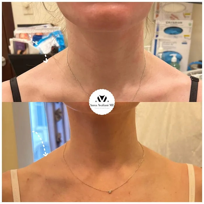 Trap tox before and after by Dr.Avaliani and discussion of the Trap tox cost