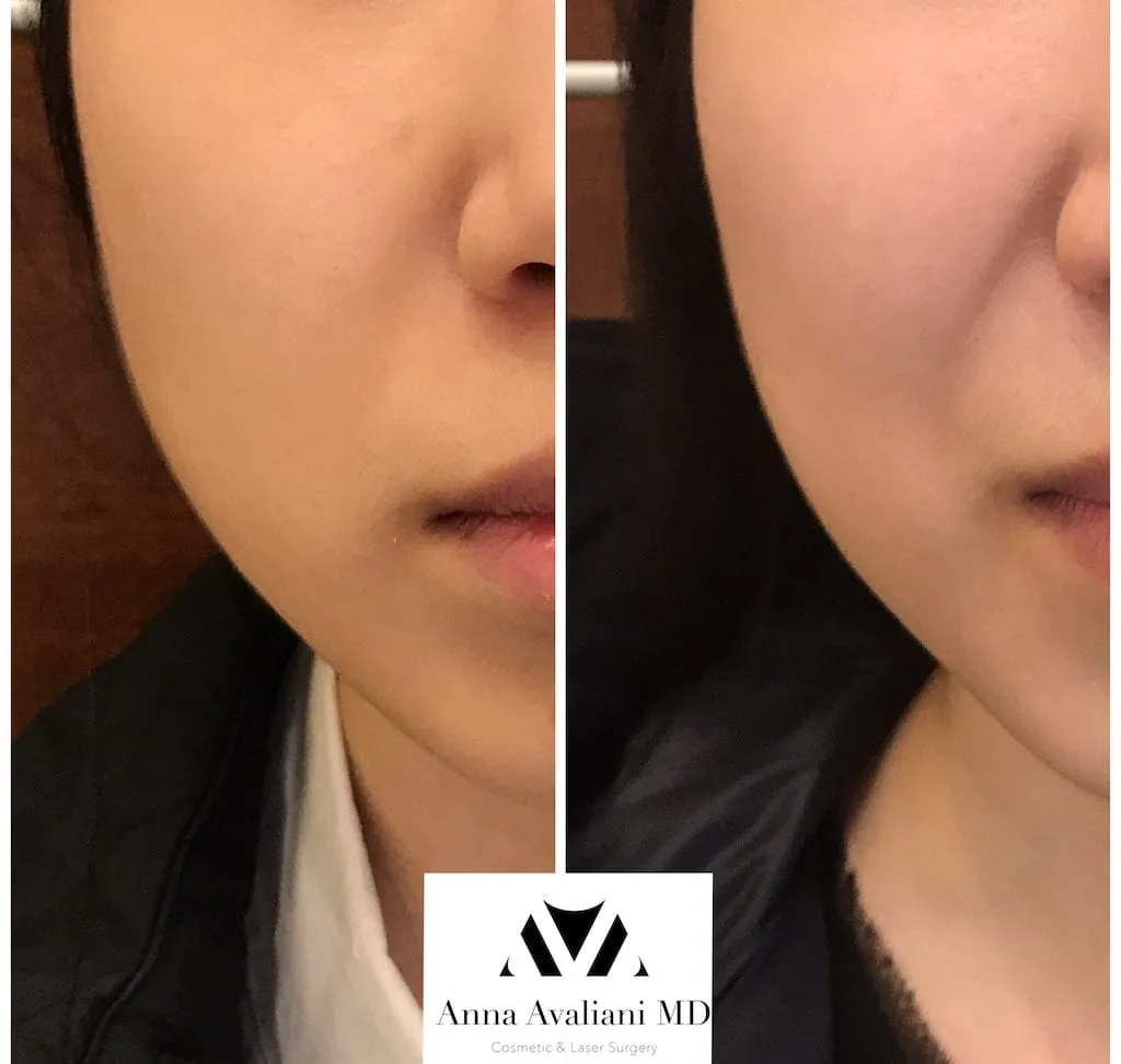 Non-Surgical Face Slimming: Combatting The Round Face Effect Of Teeth Grinding With Botox